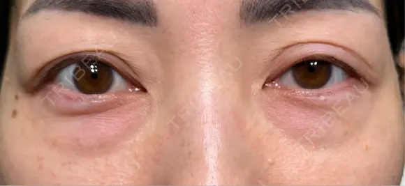 その他（目元） / クマ治療 HAAB×DREAM BEAUTY CLINIC 大阪梅田院 BEFORE メイン用