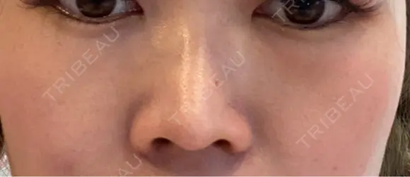 隆鼻術 / 鼻尖形成（切開） / 鼻中隔延長（切開） / 下まぶたたるみ取り / 下まぶたの脂肪取り / 軟骨移植 R Beauty CLINIC 銀座院 BEFORE メイン用