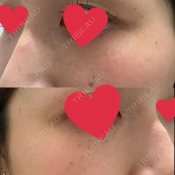 ルメッカ ルラ美容クリニック 郡山院 BEFORE メイン用
