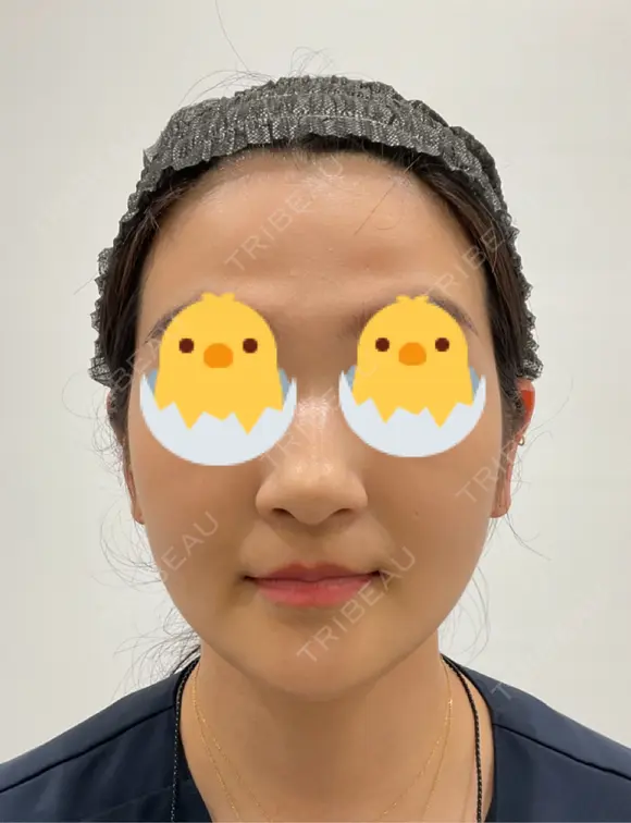 糸リフト / バッカルファット除去 / 脂肪吸引（顔） / 額を丸く / 脂肪吸引（脚） / 脂肪注入（額） / メーラーファット除去 / 脂肪注入（輪郭） First Clinic BEFORE メイン用