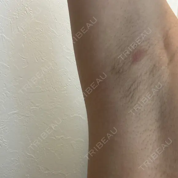 医療脱毛（ワキ） ルラ美容クリニック 新宿院 BEFORE メイン用