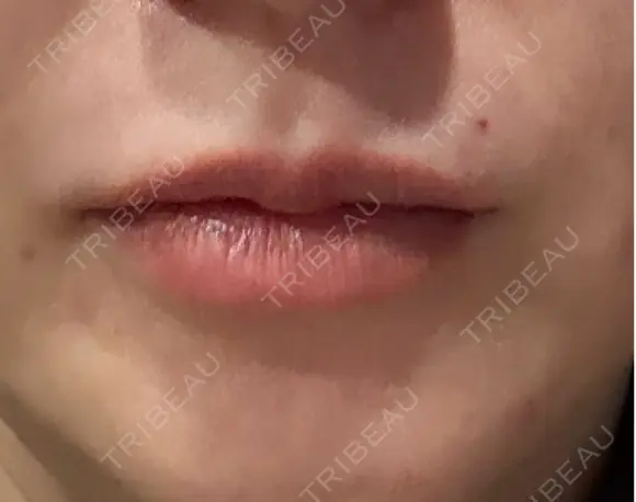 アートメイク（唇） セカジソウォン医院-明洞店 BEFORE メイン用