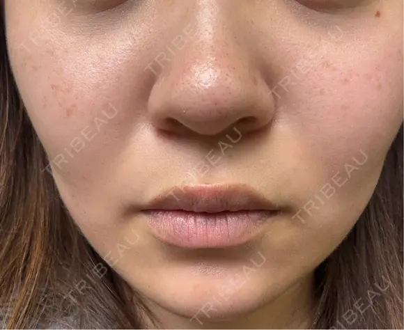 ボトックス（エラ・小顔） / ボトックス（眉間） / ボトックス（額） / ボトックス（バニーライン） Natural Skin Clinic 自由ヶ丘院 BEFORE メイン用