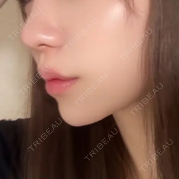 ボトックス（あご） / ヒアルロン酸注入（あご） HAAB BEAUTY CLINIC 名古屋院 BEFORE メイン用