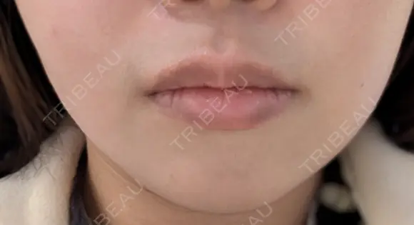 ボトックス（エラ・小顔） / ボトックス（肩） BiBiクリニック BEFORE メイン用