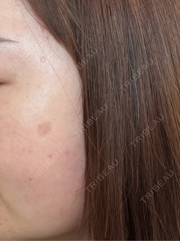 その他（肌） / シミ取りレーザー / ルメッカ ルラ美容クリニック 郡山院 BEFORE メイン用