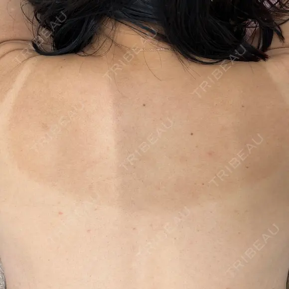 ピコフラクショナルレーザー（毛穴・ニキビ跡） ルラ美容クリニック 広島院 BEFORE メイン用