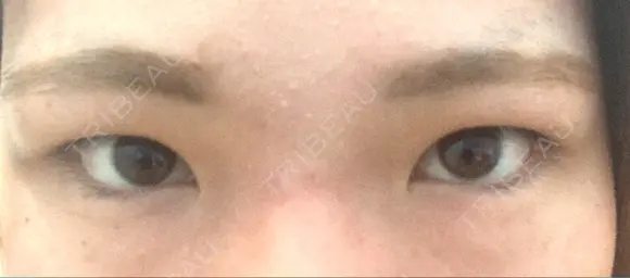 二重埋没 / 上まぶたの脂肪取り TCB東京中央美容外科 江坂院 BEFORE メイン用