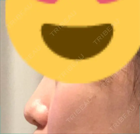 鼻尖形成（切開） / 軟骨移植 id（アイディ）美容外科 BEFORE メイン用