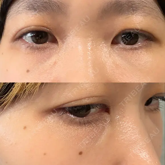 クマ治療 池袋麗歯科・美容皮膚科 BEFORE メイン用