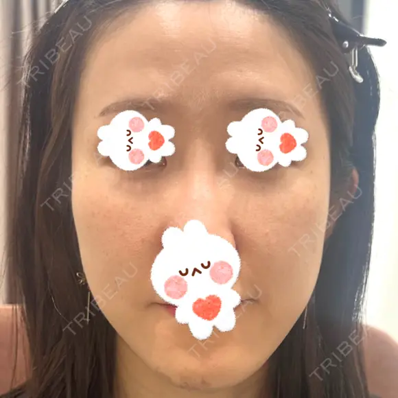 肌ヒアルロン酸注入（たるみ・シワ改善） しのぶ皮膚科 BEFORE メイン用