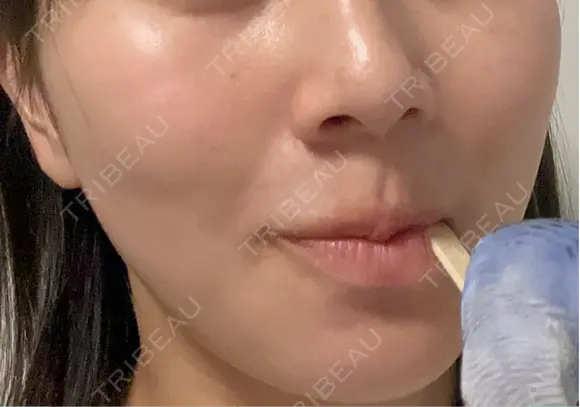 ベビーコラーゲン / ルメッカ TUNE CLINIC【チューンクリニック】 BEFORE メイン用