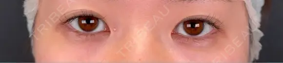 眼瞼下垂（非切開） SOL CLINIC BEFORE メイン用