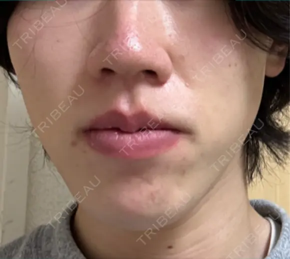 イオン導入 Kinshicho Beauty Clinic （錦糸町ビューティークリニック） BEFORE メイン用