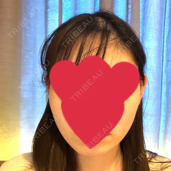 ハイフ（顔） S-Laboクリニック 渋谷院 BEFORE メイン用