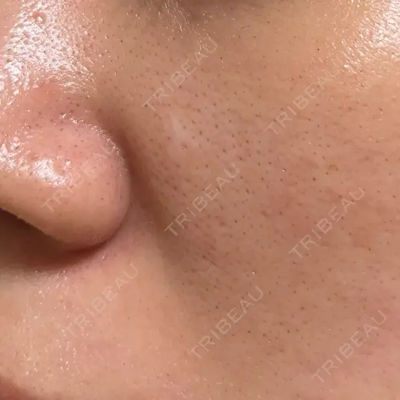 ヴェルヴェットスキン 形成外科と美容外科のクリニック池袋 BEFORE メイン用