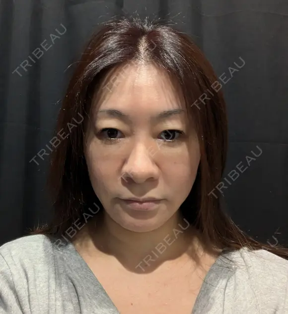 糸リフト / 脂肪吸引（顔） Wing clinic 豊中駅前院 BEFORE メイン用