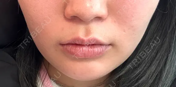 その他（輪郭） Clinic K Blossom BEFORE メイン用