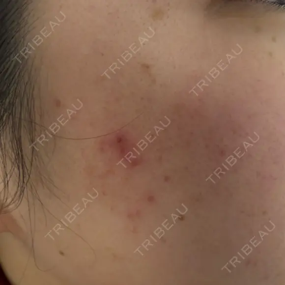 ルメッカ ルラ美容クリニック 郡山院 BEFORE メイン用