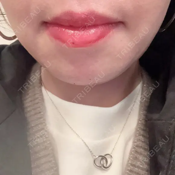 ボトックス（エラ・小顔） BiBiクリニック BEFORE メイン用