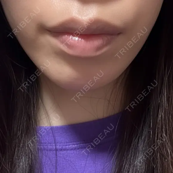 ボトックス（あご） プライベートスキンクリニック 梅田本院 BEFORE メイン用