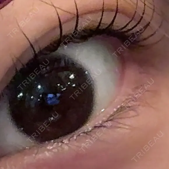 二重埋没 / 自然癒着法 形成外科と美容外科のクリニック池袋 BEFORE メイン用