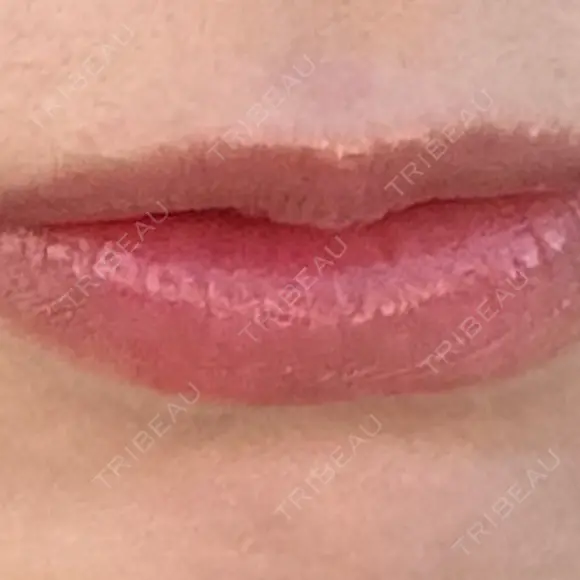 ヒアルロン酸注入（唇） Moon Beauty Clinic BEFORE メイン用