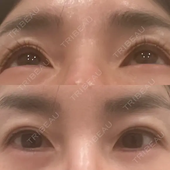 目尻切開 / タレ目形成・グラマラスライン（切開） eクリニック 大阪院 BEFORE メイン用