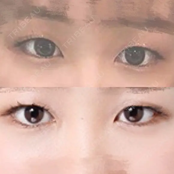 二重埋没 高須クリニック 名古屋院 BEFORE メイン用