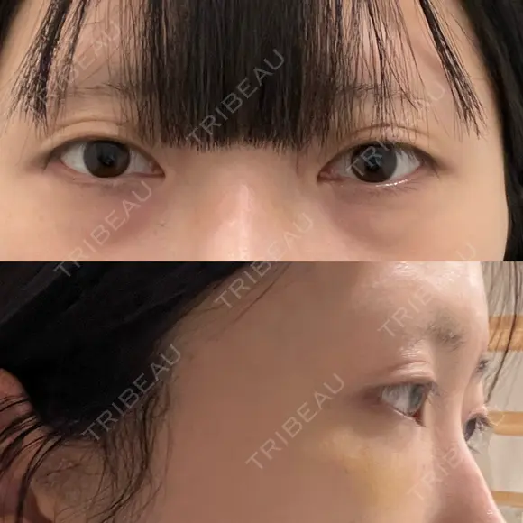 二重埋没 / 小鼻縮小（切開） / 鼻孔縁挙上 / 鼻孔縁下降 アリエル美容クリニック 郡山院 BEFORE メイン用