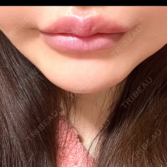 アートメイク（唇） / アートメイク（アイライン） Kinshicho Beauty Clinic （錦糸町ビューティークリニック） BEFORE メイン用