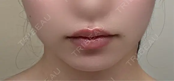 ボトックス（口角） TCB東京中央美容外科 京都駅前院 BEFORE メイン用