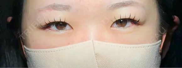 二重埋没 / 上まぶたの脂肪取り アリエル美容クリニック 大宮院 BEFORE メイン用