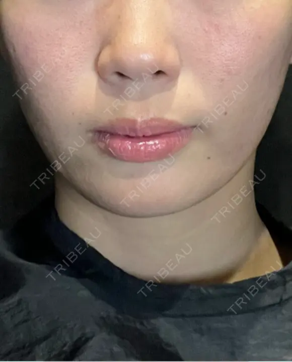 糸リフト / ボトックス（あご） / ヒアルロン酸注入（あご） / ヒアルロン酸注入（頬） Wing clinic 豊中駅前院 BEFORE メイン用