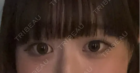 ヒアルロン酸注入（涙袋） / ヒアルロン酸注入（唇） 共立美容外科 梅田院 BEFORE メイン用