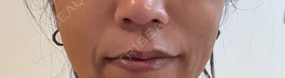 ヒアルロン酸注入（頬） Wi Clinic （ウィ クリニック）心斎橋院 BEFORE メイン用