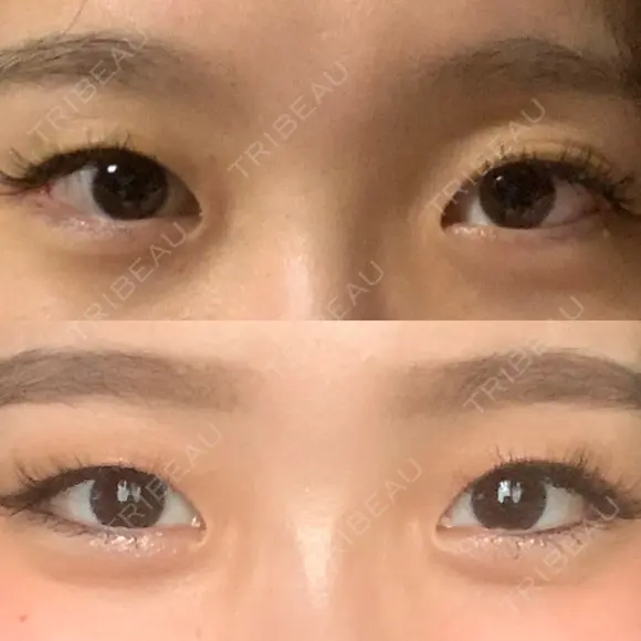 二重埋没 札幌中央形成外科 BEFORE メイン用