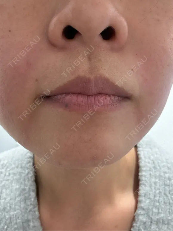 ショッピングリフト 東京シンデレラ美容外科 新宿院 BEFORE メイン用