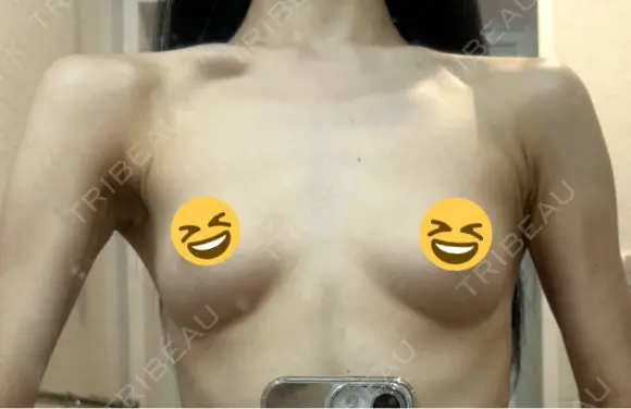 豊胸（シリコンバッグ） お茶の水美容形成クリニック BEFORE メイン用