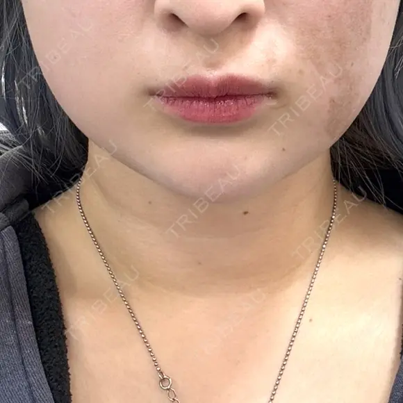 ボトックス（エラ・小顔） 新未来クリニック BEFORE メイン用