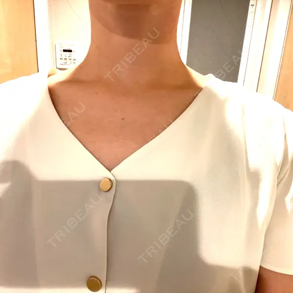 ボトックス（肩） / ワキ汗治療（ボトックス） APスキンクリニック銀座 BEFORE メイン用