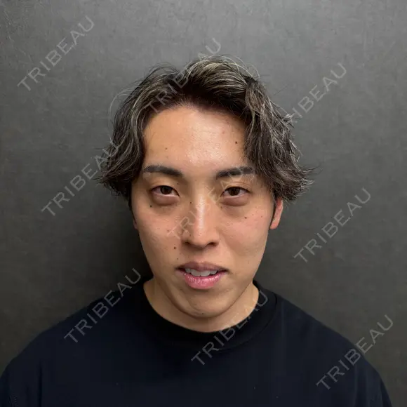 クマ治療 / ヒアルロン酸注入（目の下） / その他（目元） ネビュラクリニック 京都院 BEFORE メイン用