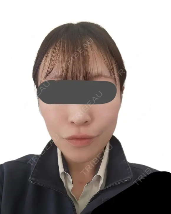 シワ取りボトックス / ピコレーザートーニング（美白・肝斑） / ピコフラクショナルレーザー（毛穴・ニキビ跡） 東京シルククリニック 東京神田院 BEFORE メイン用