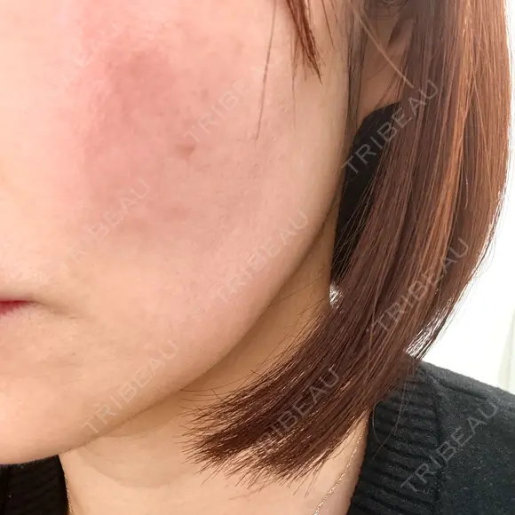 その他（輪郭） ルラ美容クリニック 大宮院 / ルラスキンクリニック 大宮院 BEFORE メイン用