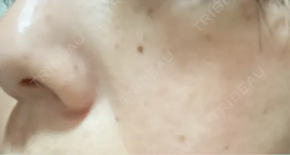 ピーリング（ニキビ・毛穴） / エレクトロポレーション / 光治療（フォトフェイシャルなど） 共立美容外科 仙台院 BEFORE メイン用