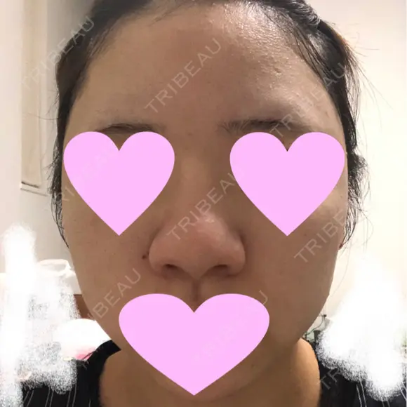 鼻中隔延長（切開） / 小鼻縮小（切開） / 軟骨移植 / 鼻尖縮小 / 鼻孔縁下降 / その他（鼻） 加美（GAMI）整形外科 BEFORE メイン用