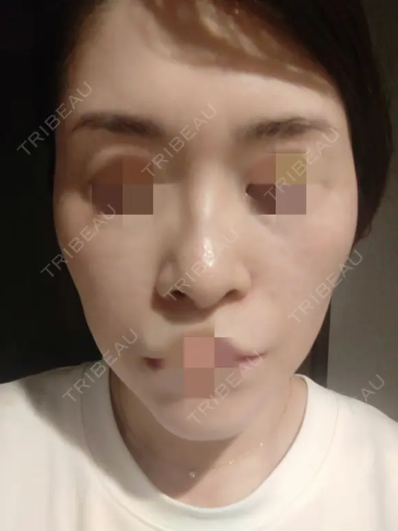 糸リフト 形成外科と美容外科のクリニック池袋 BEFORE メイン用