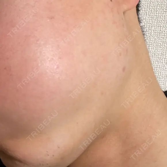 光治療（フォトフェイシャルなど） / 医療脱毛（全身） しんゆり美容健康クリニック BEFORE メイン用