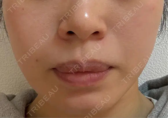 光治療（フォトフェイシャルなど） 品川美容外科 渋谷院（※品川スキンクリニック提携） BEFORE メイン用