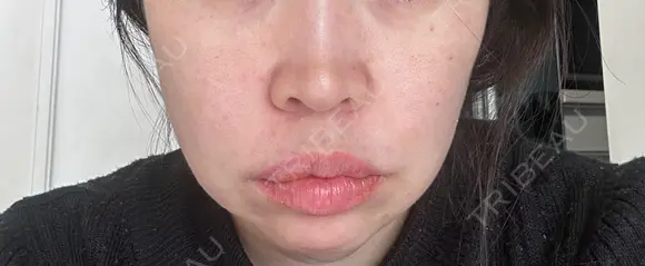 糸リフト / ボトックス（口角） 形成外科と美容外科のクリニック池袋 BEFORE メイン用